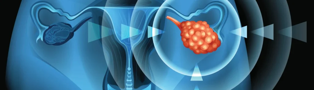 embolisation prostate